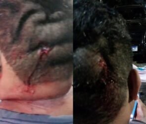 Blogueiro baleado; bala atravessou pele atrás da cabeça